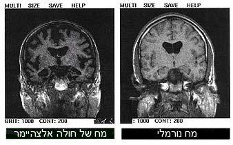 מי חולה באלצהיימר? נטע