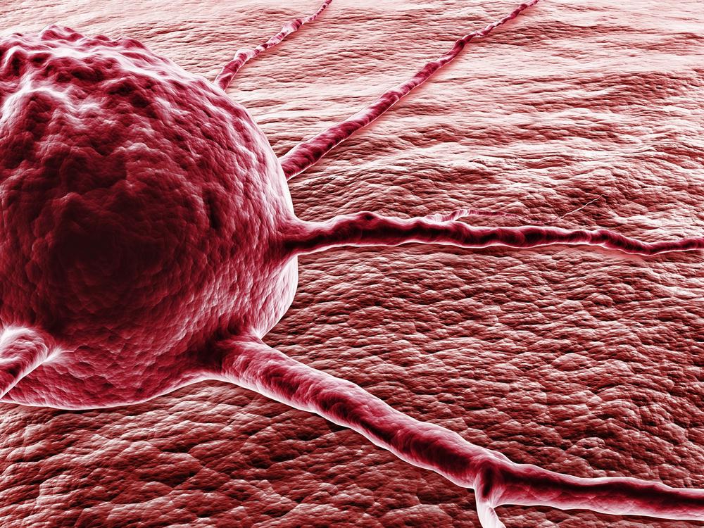 סרטן השד – ממוגרפיה