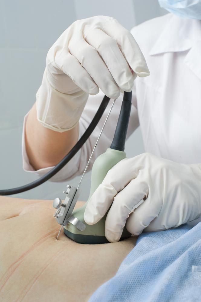 דיקור מי שפיר