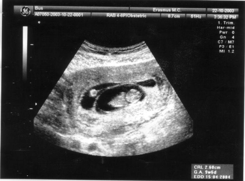 האם אפשרי שגנים של תאומים זהים לא יהיו בדיוק אותו דבר? משי