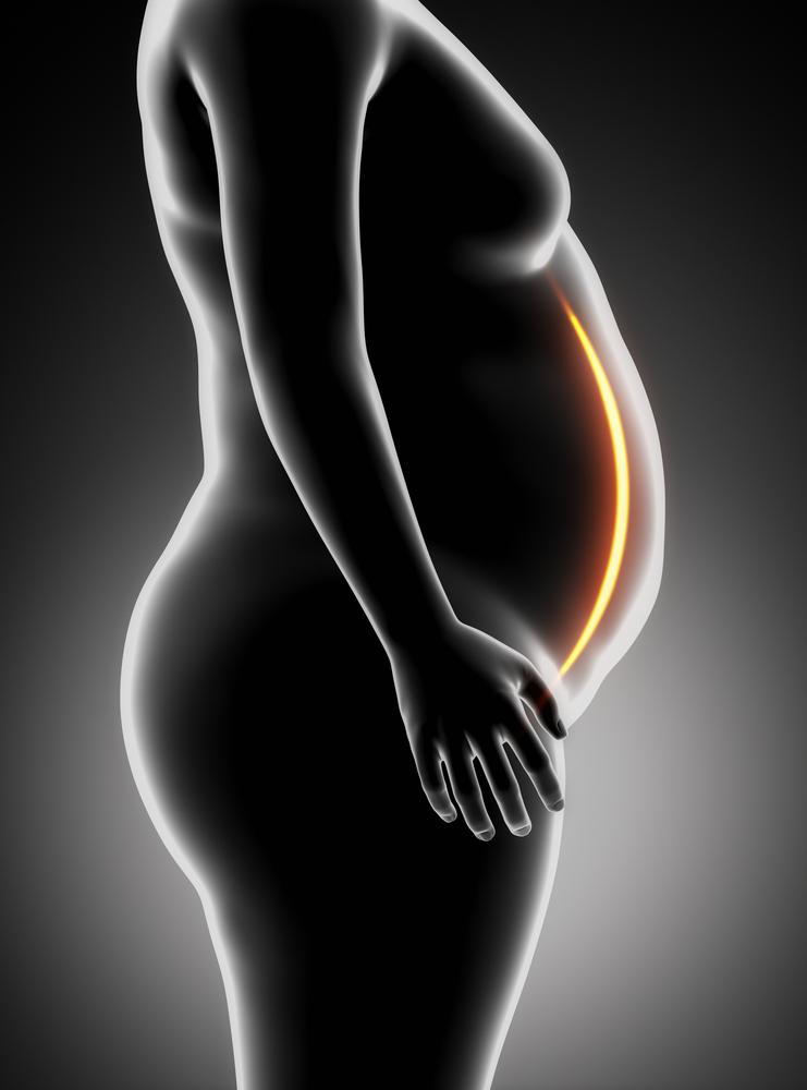 ניתוח קיצור קיבה