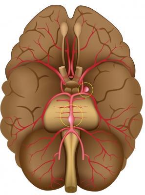 מחסום דם-מוח