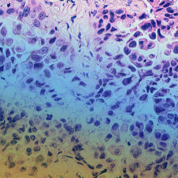 התאים המהונדסים נגד גידולים מוצקים