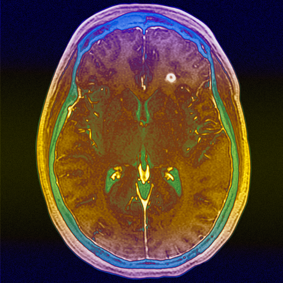 השתלת מוח עצם נגד טרשת נפוצה