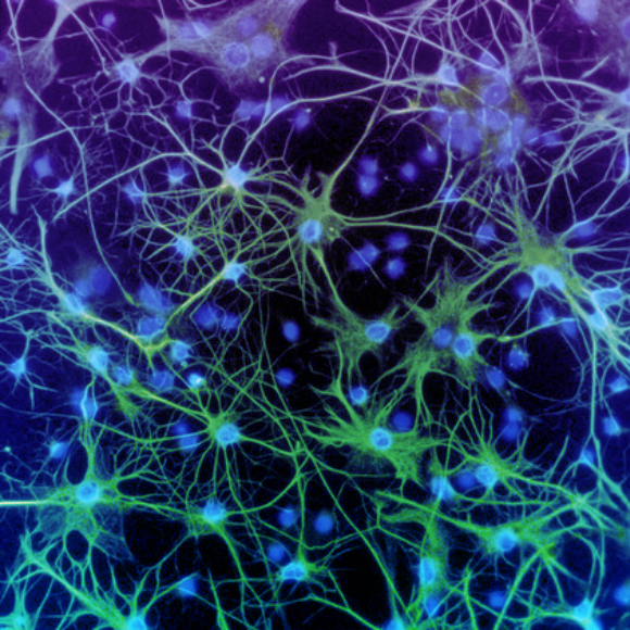 כך מתפתחות גרורות סרטניות במוח