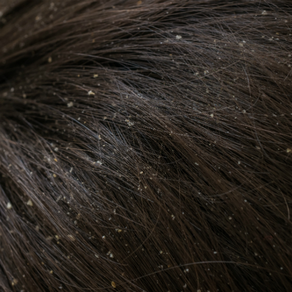 מה גורם לקשקשים ואיך אפשר להיפטר מהם?