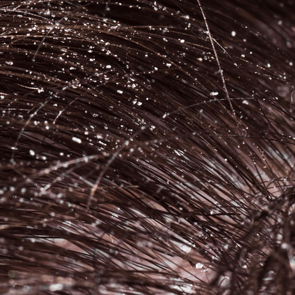 What causes dandruff and how to get rid of it?‎