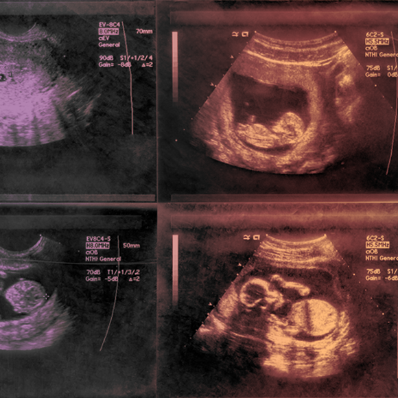 על אוטיזם, אולטרסאונד ומחקר בעייתי