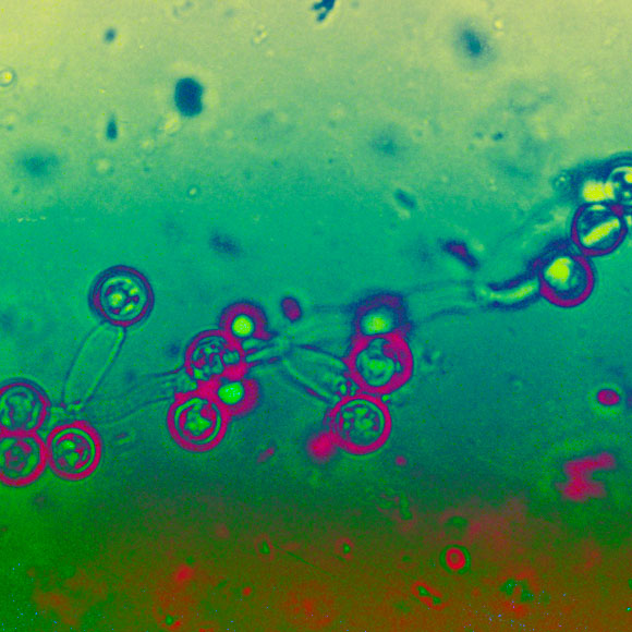 הפטרייה שכמעט הרגה את בוב דילן