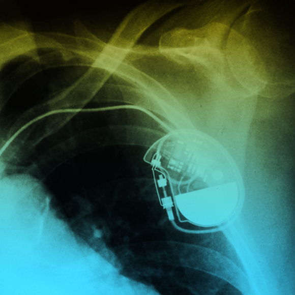 לראשונה: קוצב לב ביולוגי