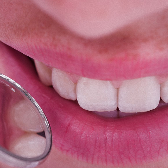 מצהוב לצחור: הלבנת שיניים