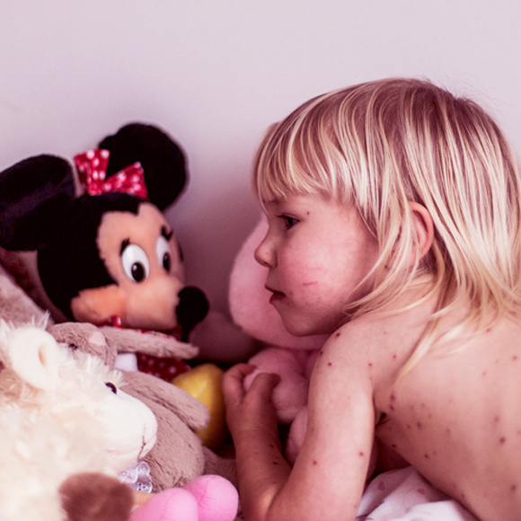 אבעבועות רוח: לא סיבה למסיבה