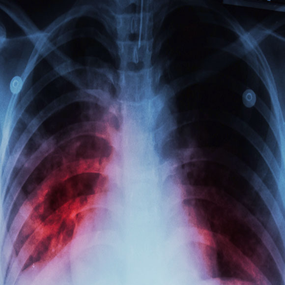 שחפת: המחלה העיקשת