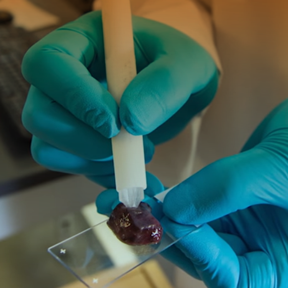 העט שיסייע באבחון סרטן