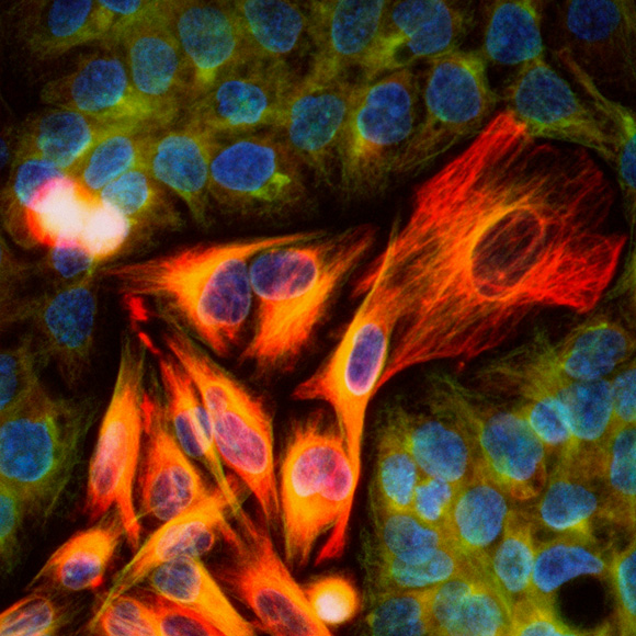 תאי סרטן מכורים לתרופות