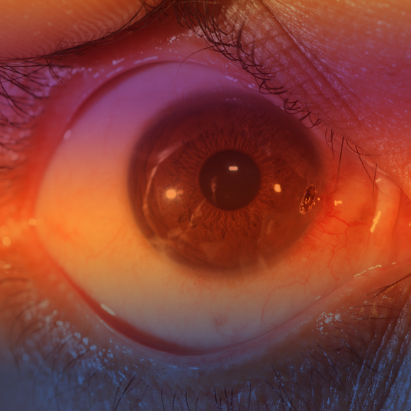 אושר טיפול גֵני ראשון למחלת עיניים ניוונית