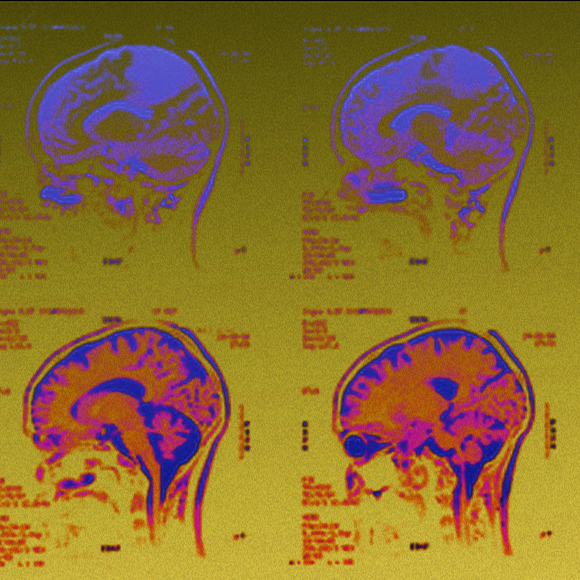 הנגיף שעוזר למוח להילחם בסרטן