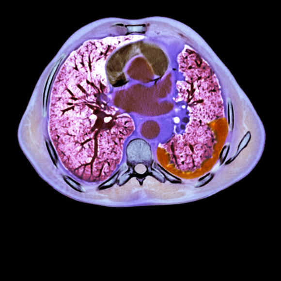 האנזים שמאיץ את הסרטן הקטלני