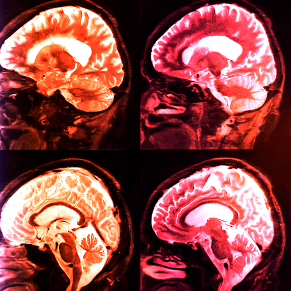 מדוע יש אנשים שחסינים לאלצהיימר?