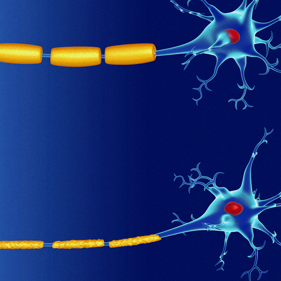 בין הגורמים לטרשת נפוצה: חום ומליחות