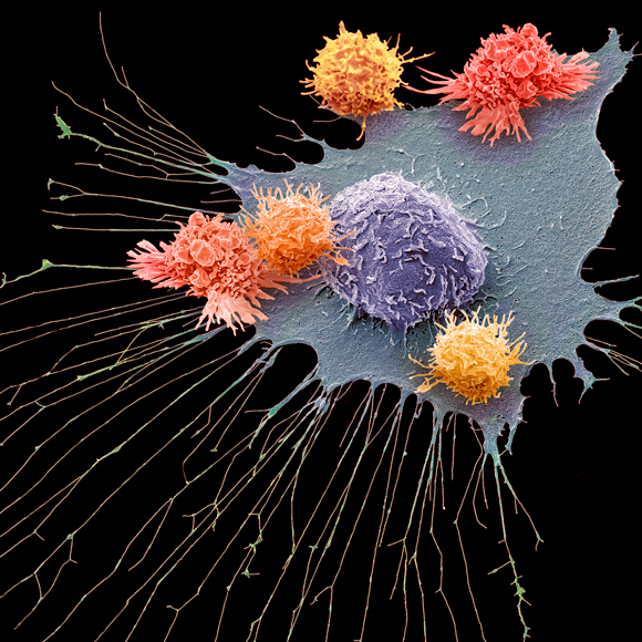 התאים המהונדסים שנלחמים בסרטן