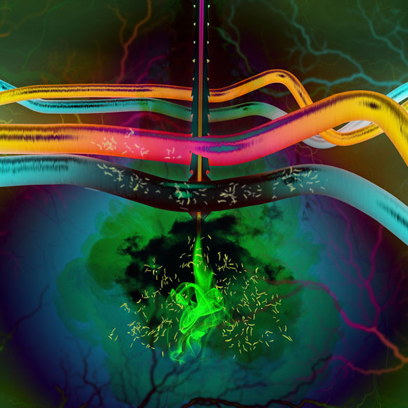 מלריה עמידה לתרופות מתפשטת באסיה