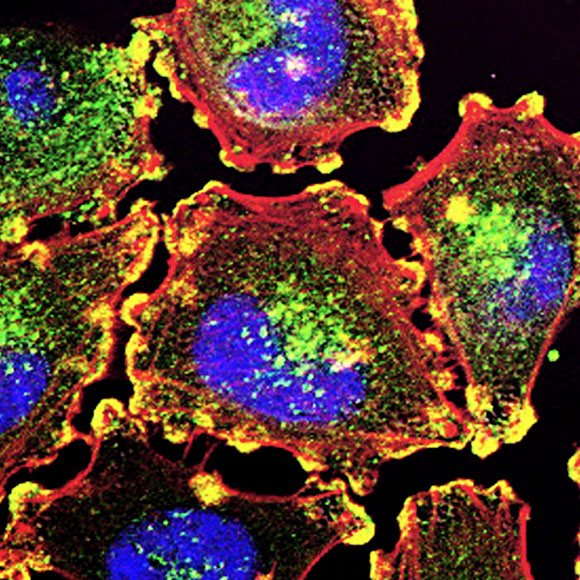 הגיוון המסוכן של תאי המלנומה