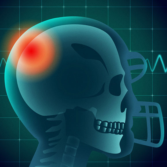 כדורגל מקצועני מגדיל את הסיכון לאלצהיימר