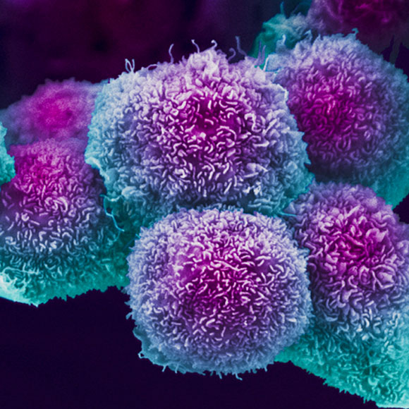 הפטרייה שגורמת לסרטן בלבלב