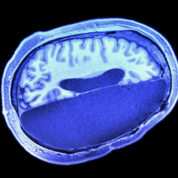 מחקר חושף: גם חצי מוח זה מספיק