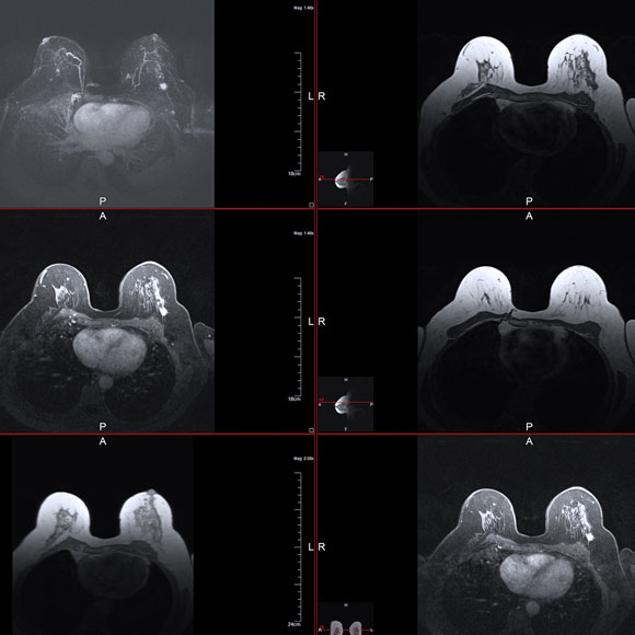 הבדיקה המשלימה לממוגרפיה: MRI