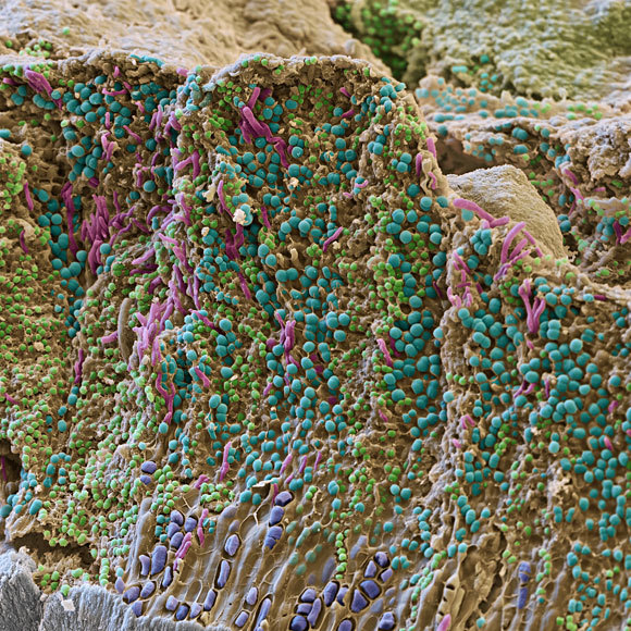 הנזק ההיקפי של מחלות חניכיים