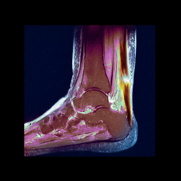 לתקן גידים – בלי צלקות