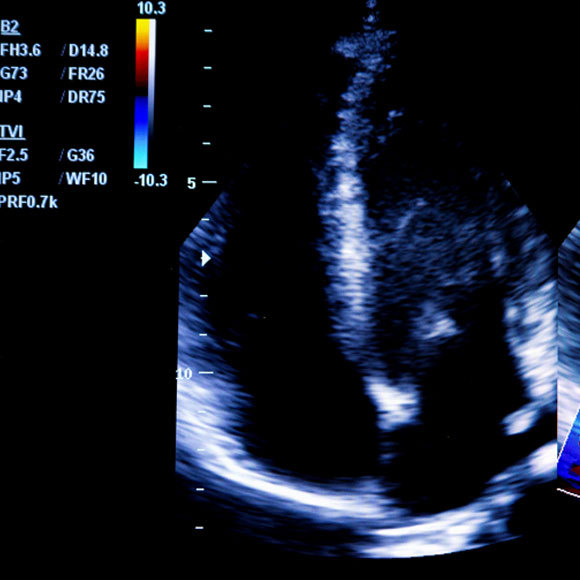 אולטרסאונד במהירות האור