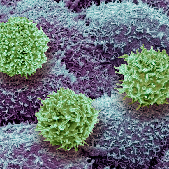 علاج للسّرطان يقاوم فيروس HIV