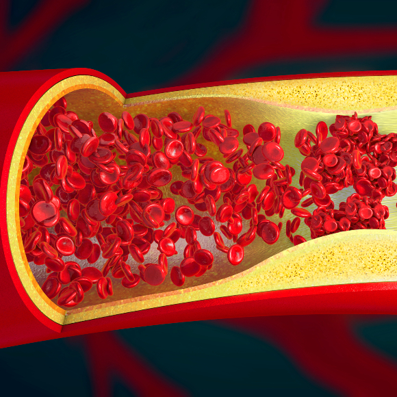 פיתוח: מעכב קרישה שאינו מגדיל את הסיכון לדימום