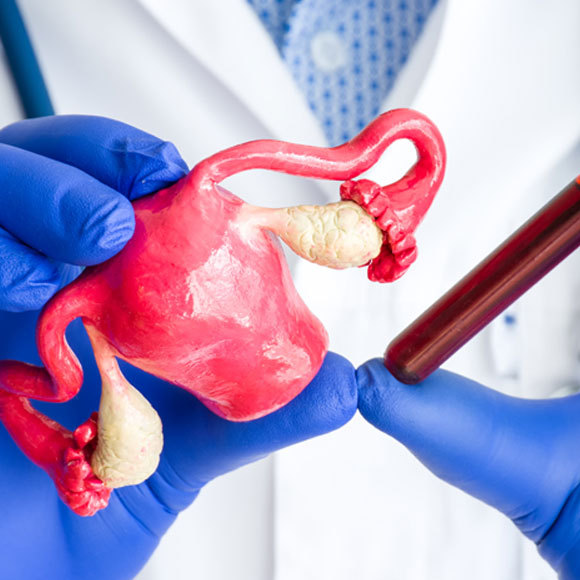 ما هي متلازمة تكيّس المبيضَين؟