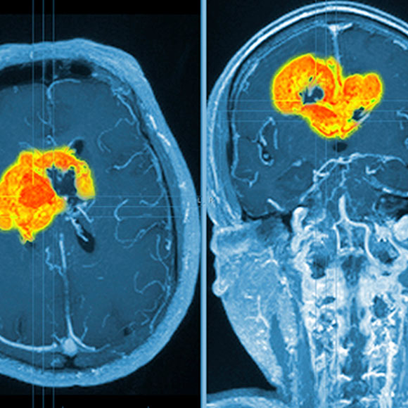 الخلايا السّرطانيّة الّتي تتنكّر لخلايا أعصاب