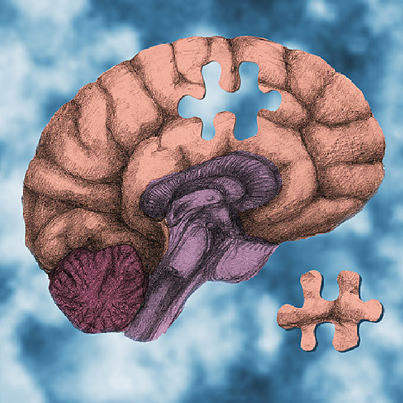 המחלוקת על התרופה החדשה לאלצהיימר