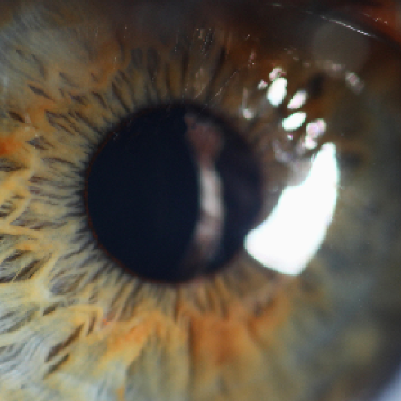 האצה שהראתה לעיוור את האור