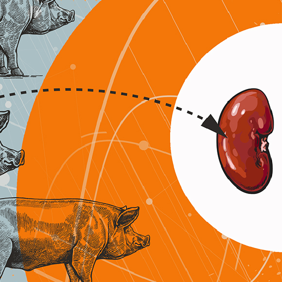 לראשונה: הושתלה כליית חזיר בגוף אדם