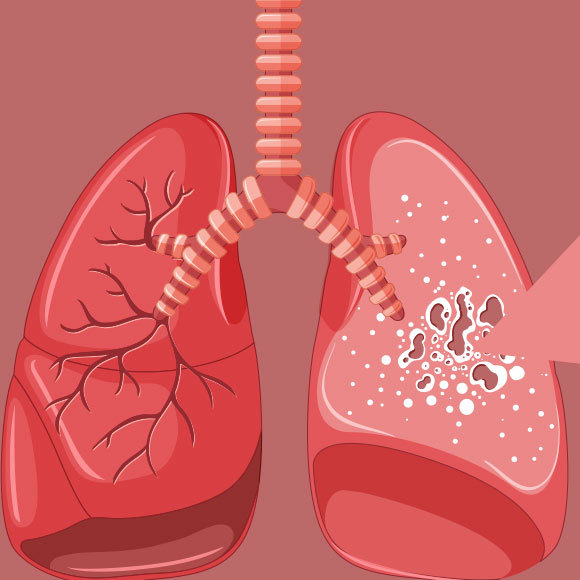 שחפת בצל הקורונה