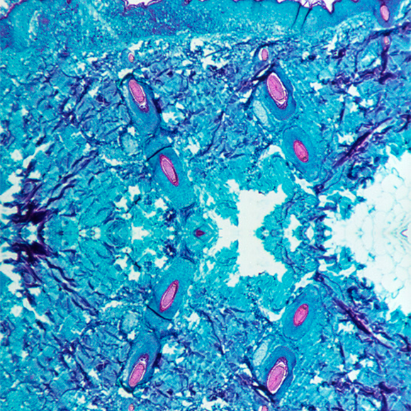 Fear of an Outbreak of Monkeypox