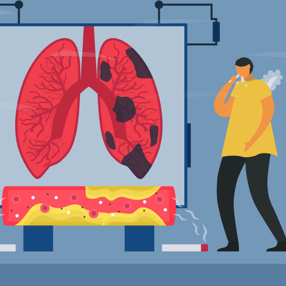מחלת הריאות שכולנו מתעלמים ממנה