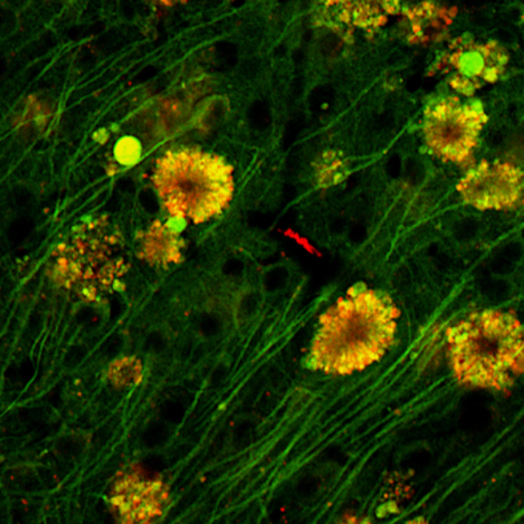 האם הסיבה לאלצהיימר אינה מה שחשבנו?