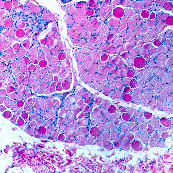 ניוון שרירים על שם דושן