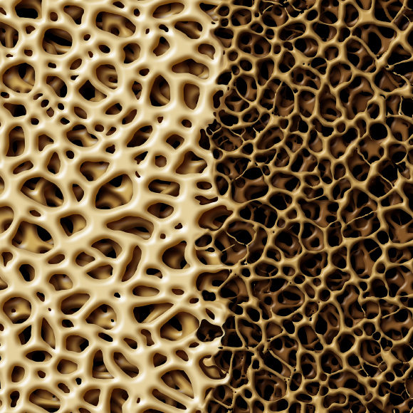 כשהעצמות מתפוררות