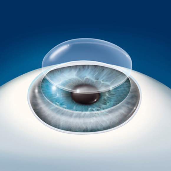 רואים את האור עם קרניות מהונדסות