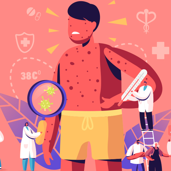 חצבת באפריקה: מחלות ללא גבולות