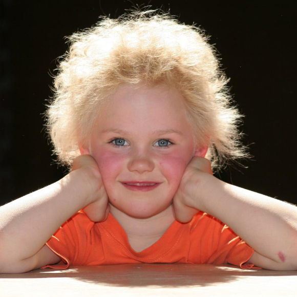 متلازمة الشعر غير القابل للتمشيط